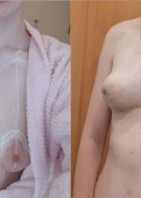 Анатомические импланты