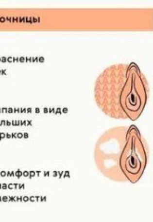Молочница у женщин на сосках