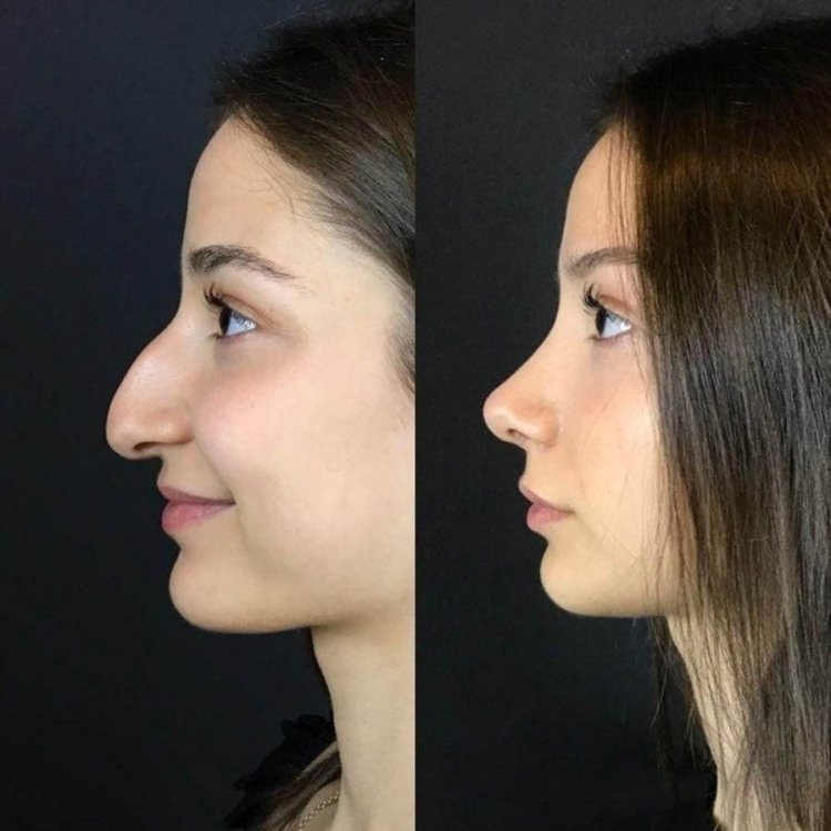 Зарема Тагирова ринопластика