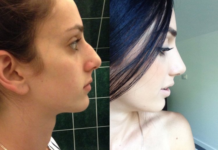 Ринопластика горбинки носа