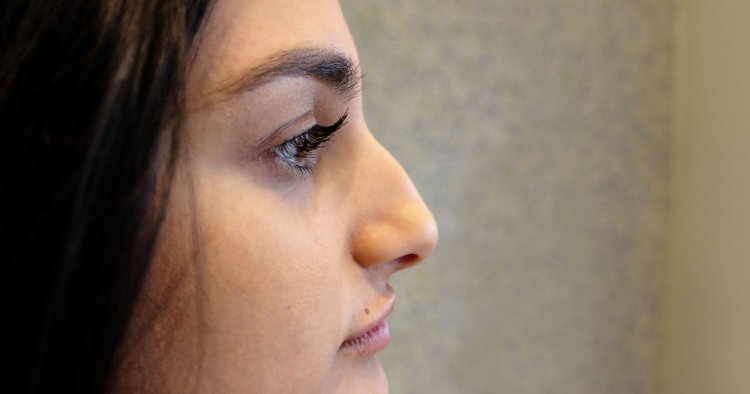 Ринопластика красивый нос