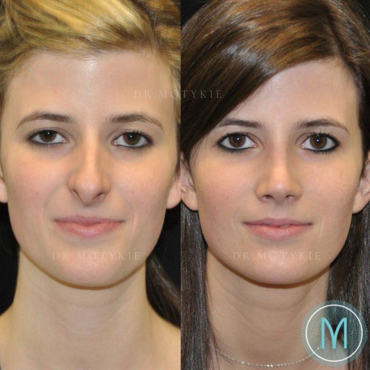 Аннабель Уотсон нос ринопластика