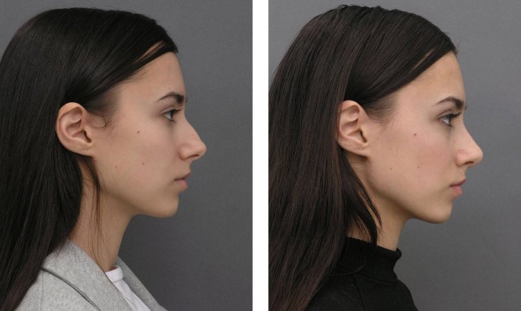 Греческий профиль нос с горбинкой