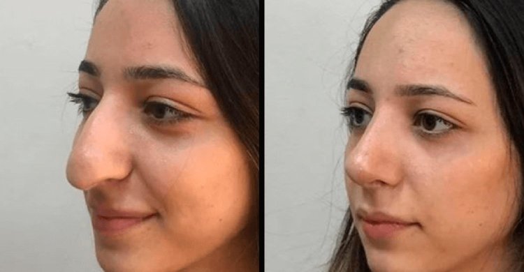 Нос армянки