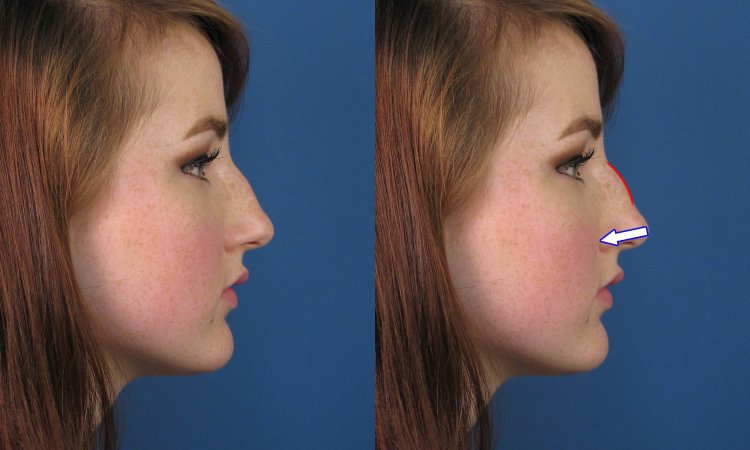 Прямой нос с небольшой горбинкой