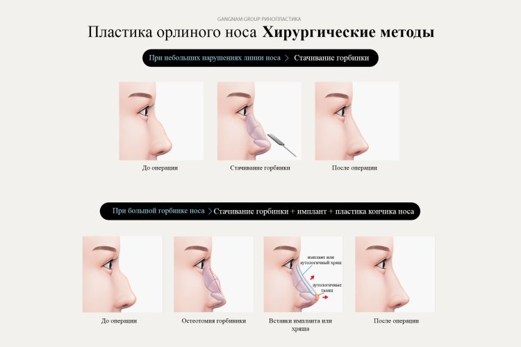 Курносый нос у девушки