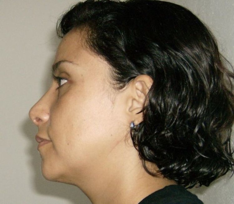 Ринопластика орлиного носа