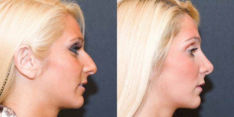 Безоперационная ринопластика филлерами