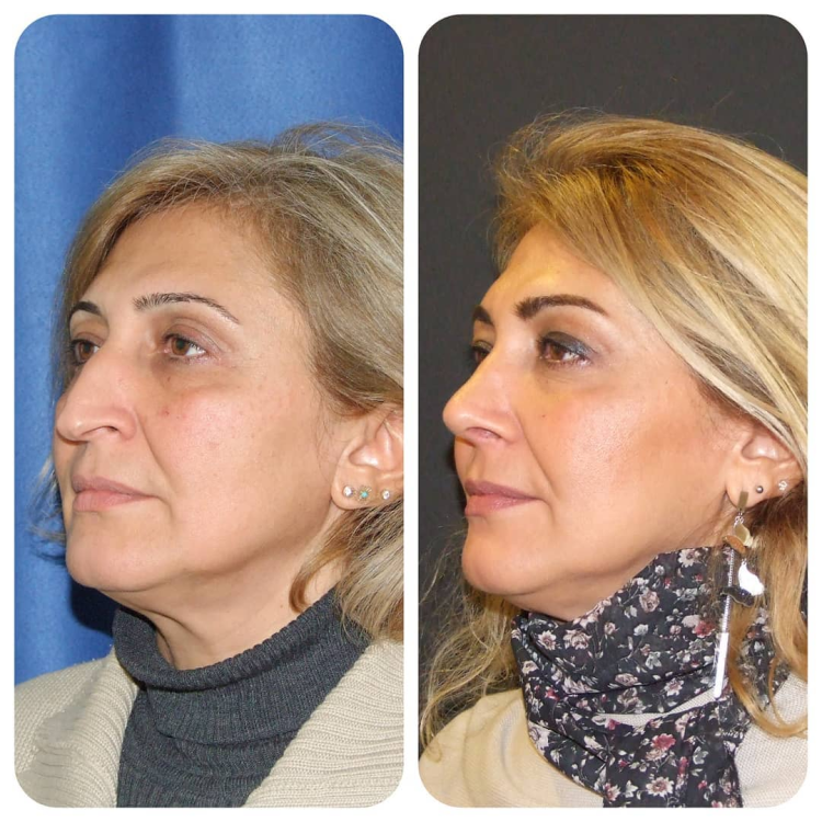 Женский нос