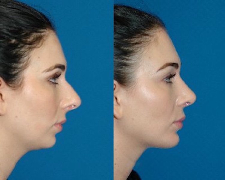 Аугментационная ринопластика