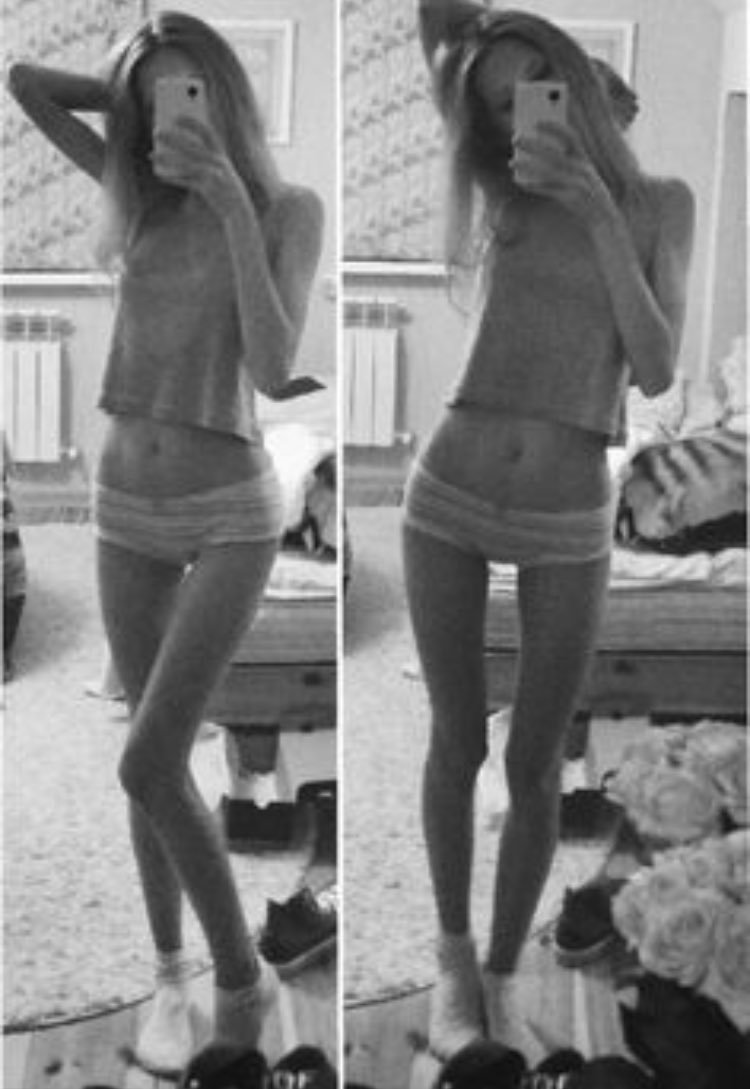 Анна Жолобова анорексия