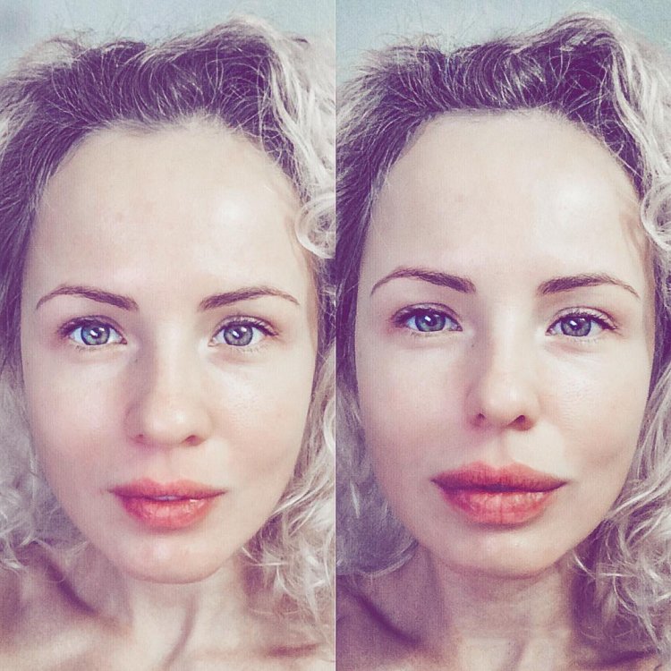 Веснушки на носу