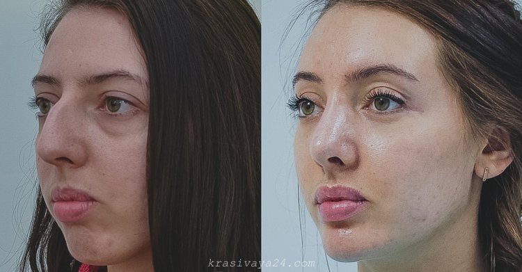 Ринопластика до и после
