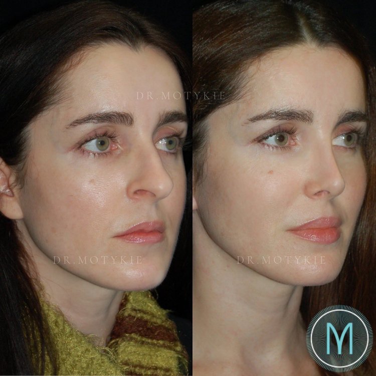 Ринопластика горбинка