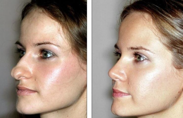 Сильва Акопян ринопластика