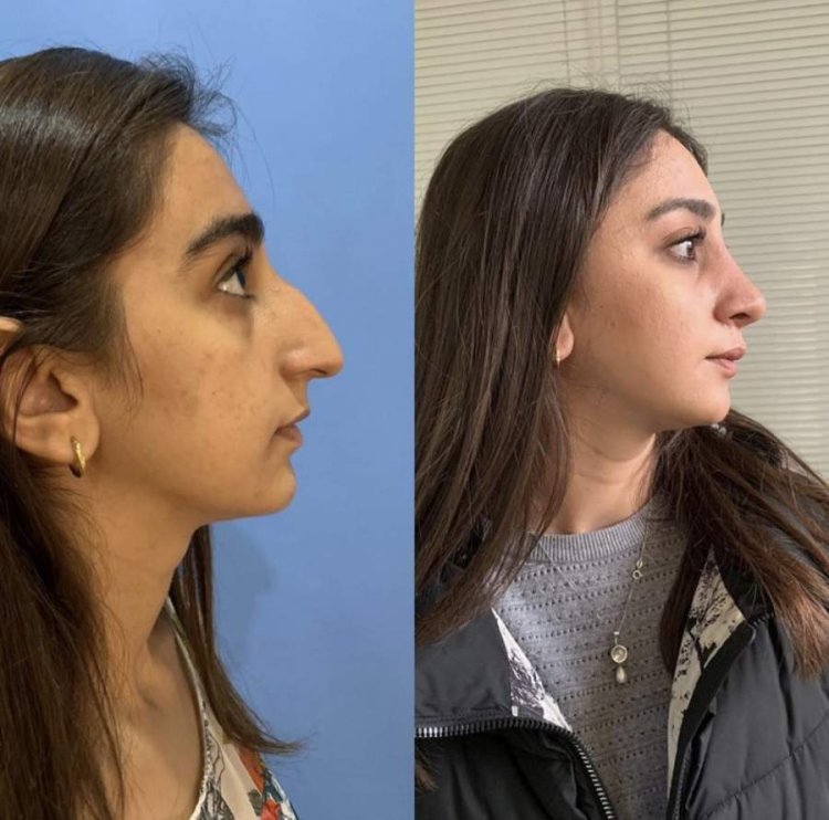 Нос с горбинкой у девушки