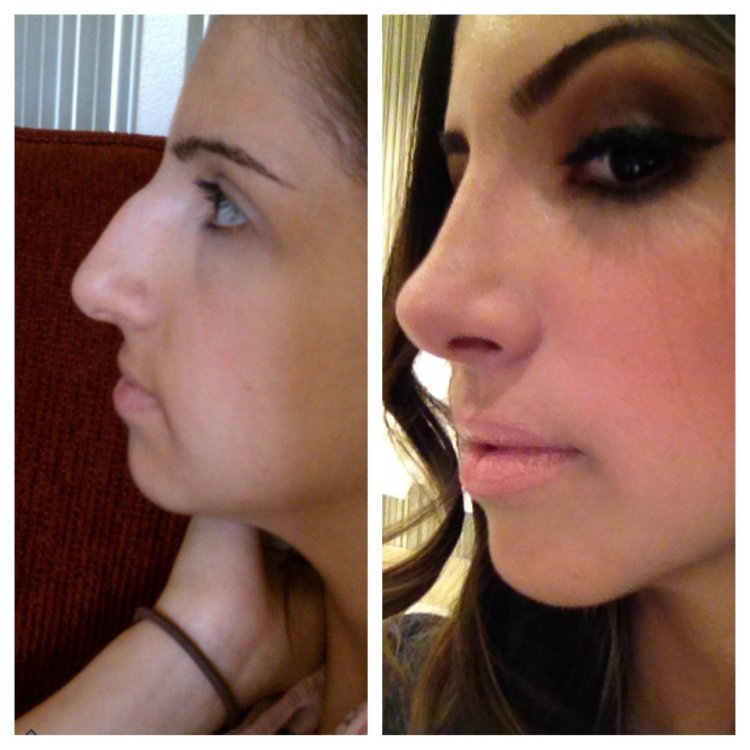 Нос армянки