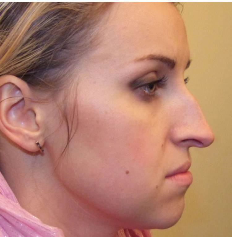 Нос с горбинкой у мужчин