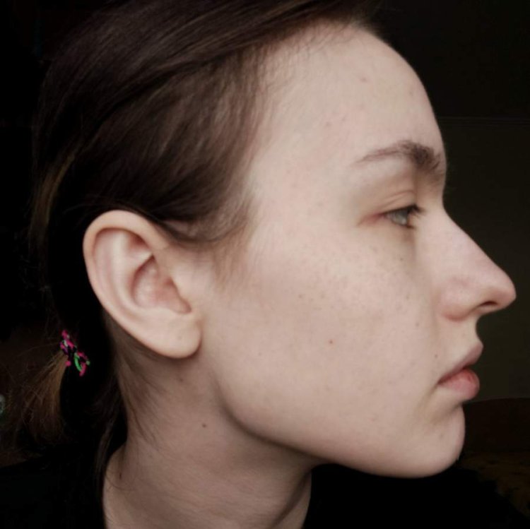 Ринопластика горбинка