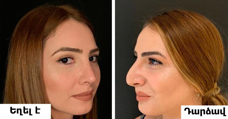 Азербайджанец с большим длинным носом