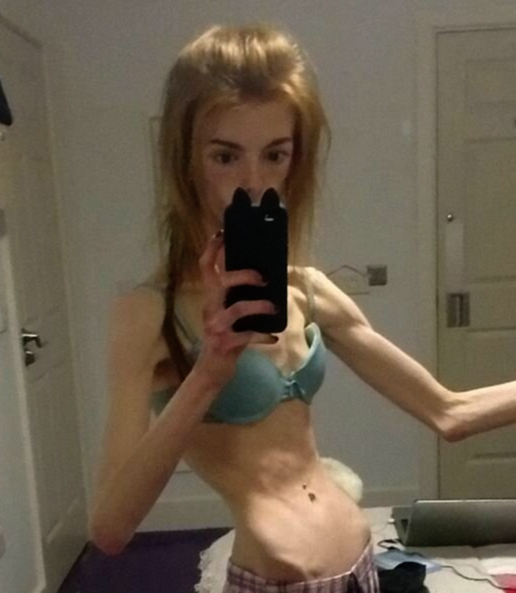 Голые анорексичные девочки