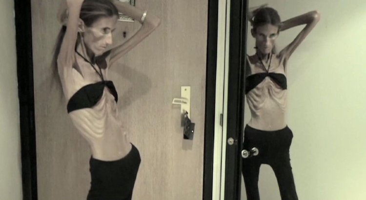 Лина Ежевская анорексия