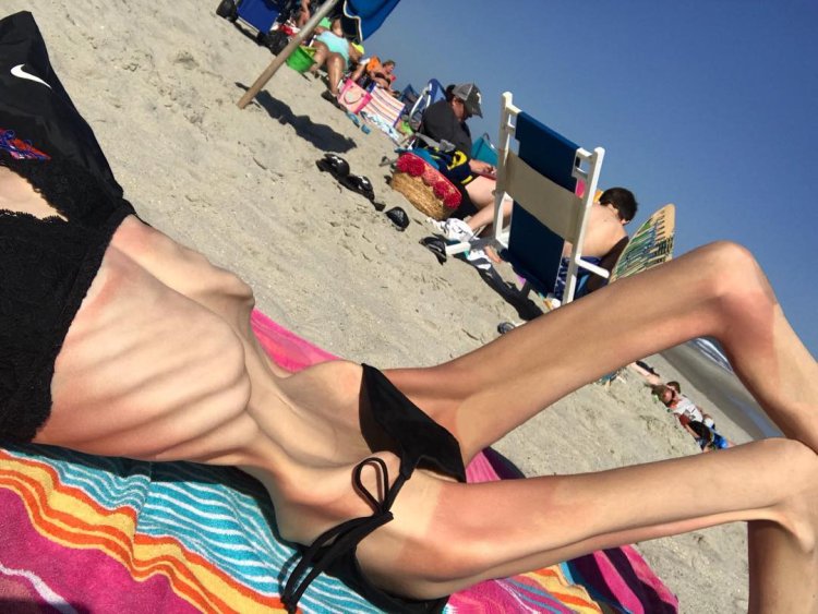 Маргарита Асланян анорексия