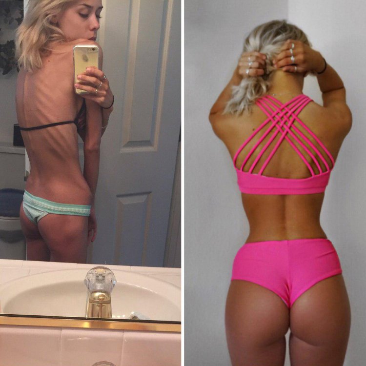 Анорексичка в купальнике