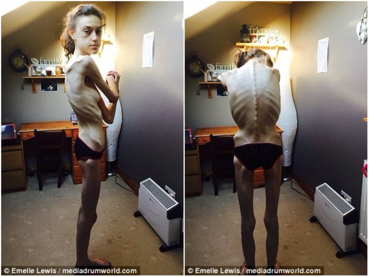 Полина Гагарина анорексия