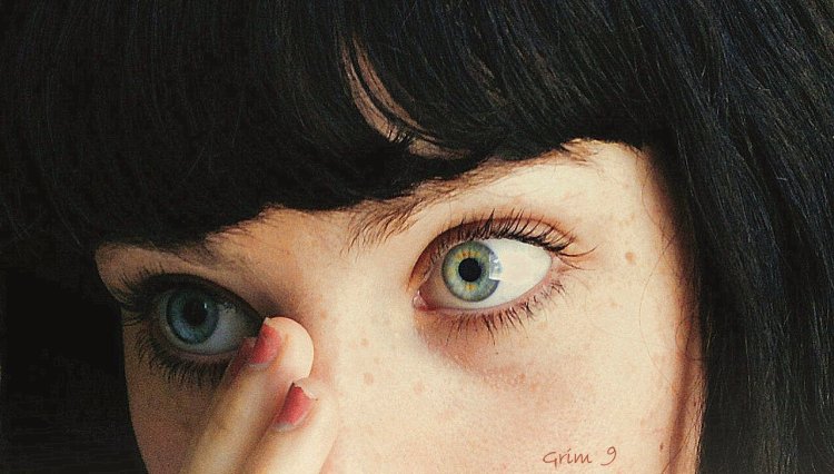 Паралитический мидриаз