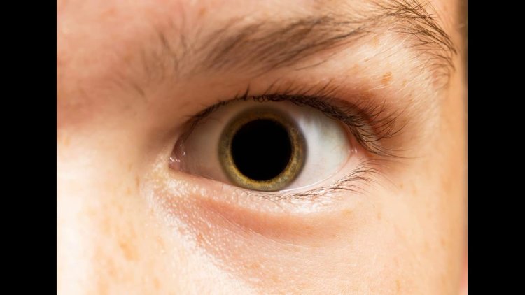 Мидриаз это в офтальмологии