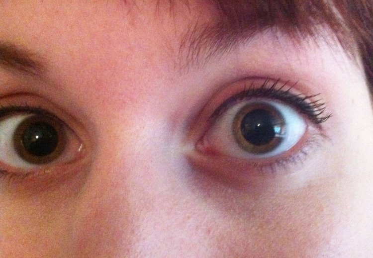 Триада горнера птоз миоз энофтальм