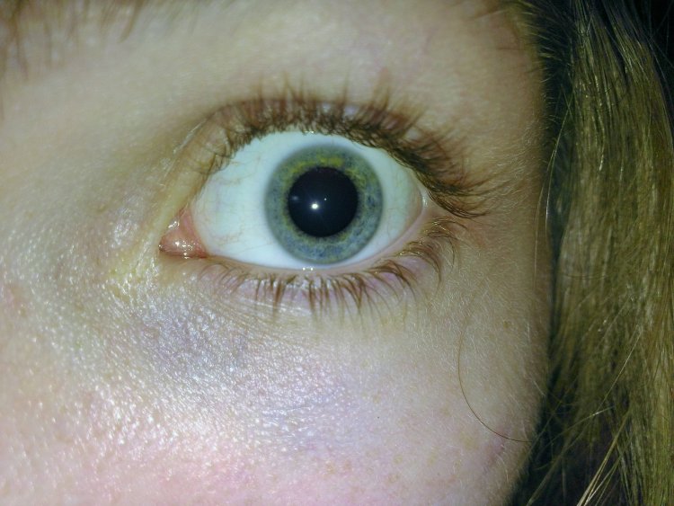 Мидриаз медикаментозный