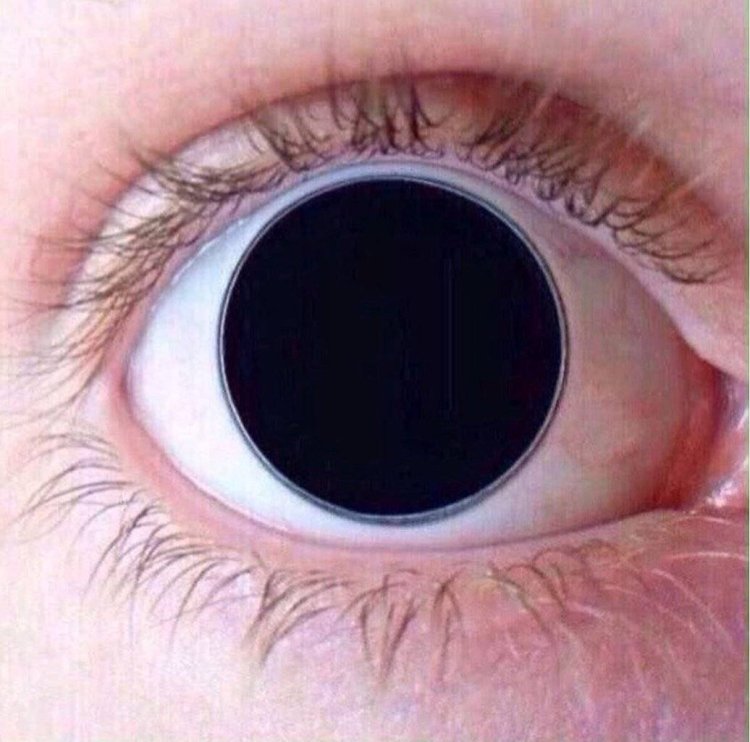 Паралитический мидриаз