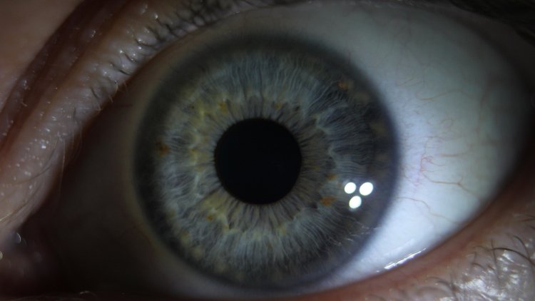 Травматический мидриаз