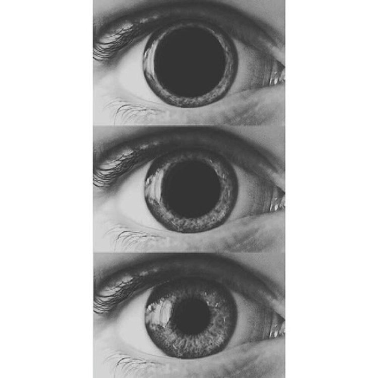 Голубой зрачок с анизокорией