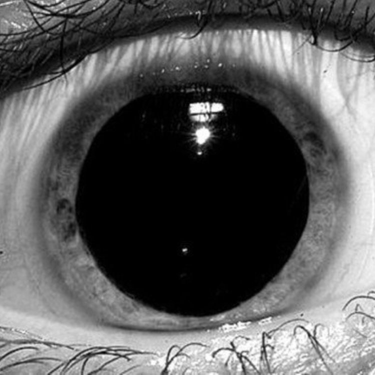 Паралитический мидриаз