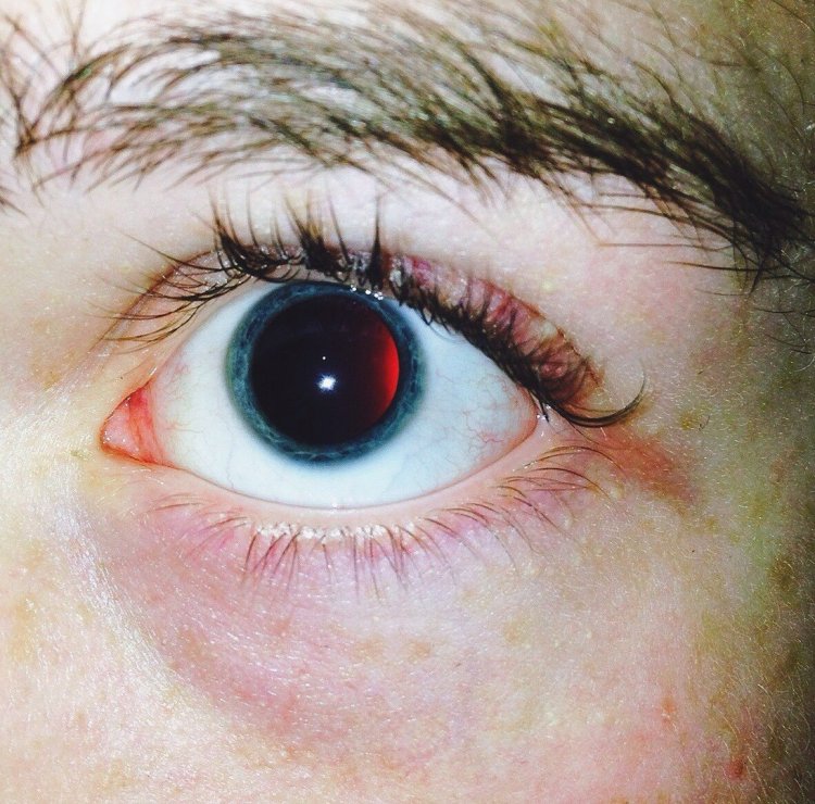 Реакция зрачков на свет