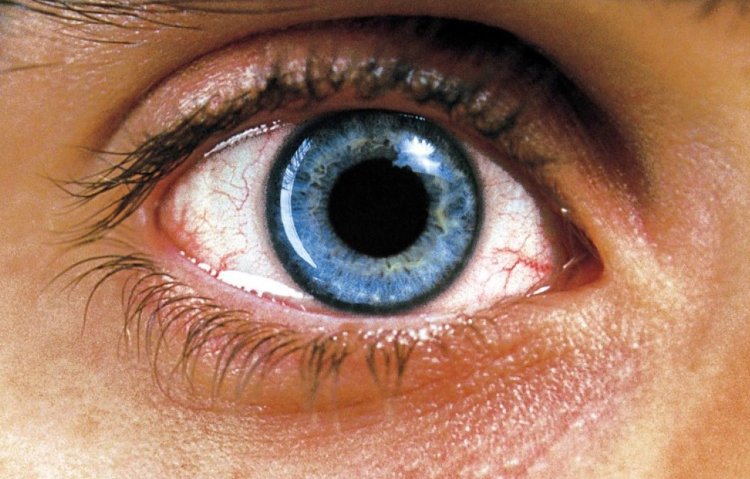 Герпетический кератоконъюнктивит