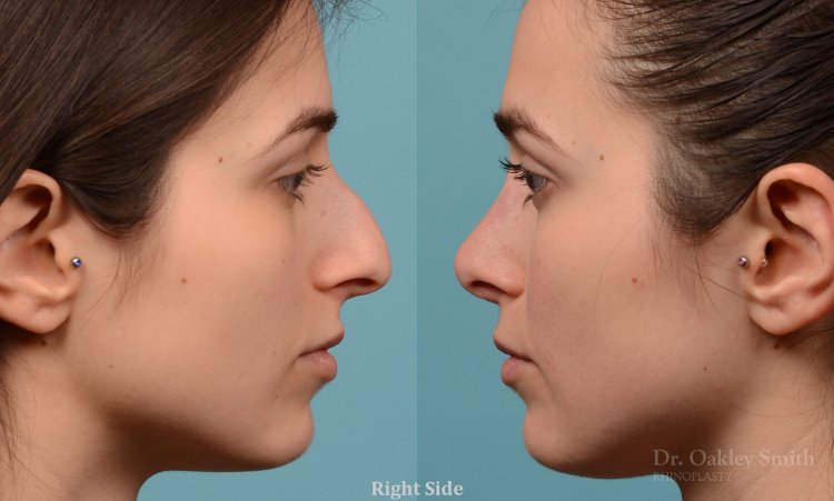 Нос с горбинкой в профиль