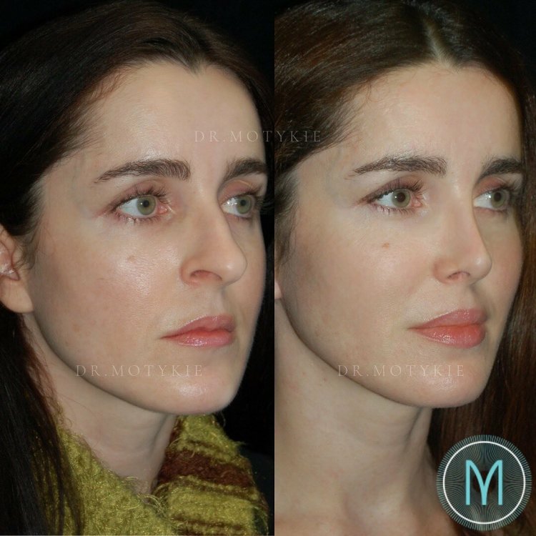 Ринопластика до и после