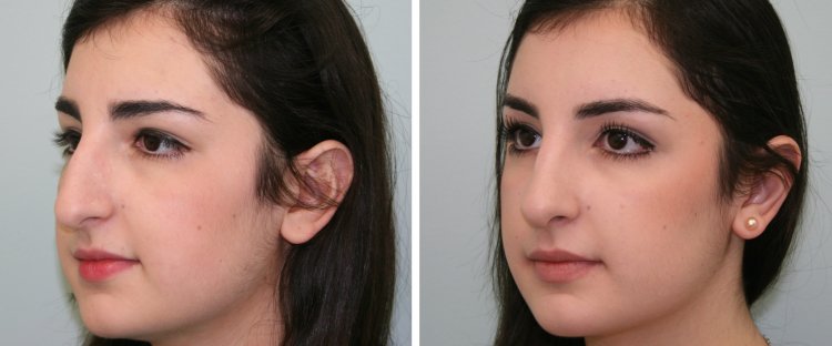 Иса Абдулазизович ринопластика