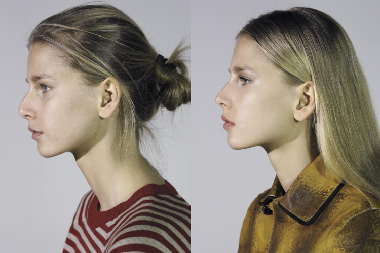 Пластика кончика носа