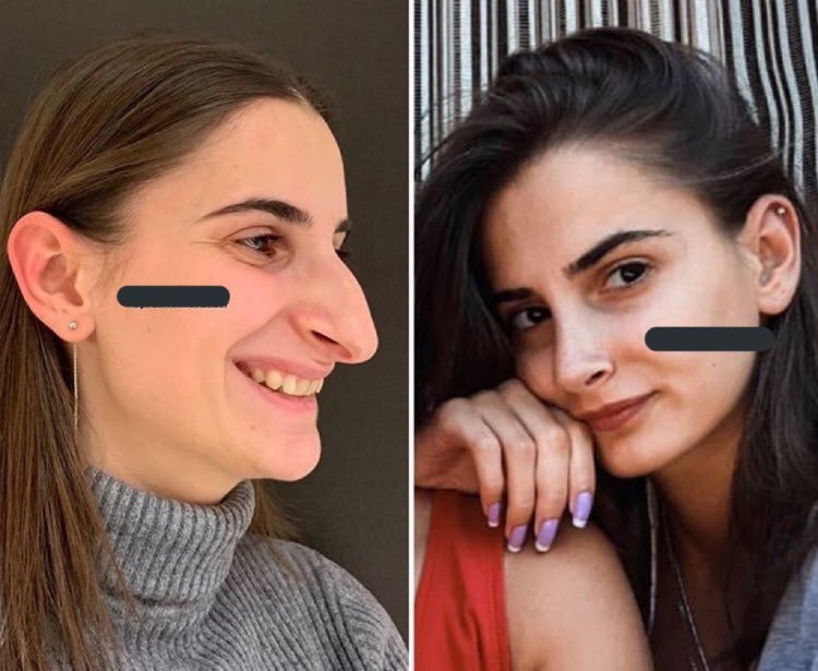 Элеонора Мовсисян ринопластика