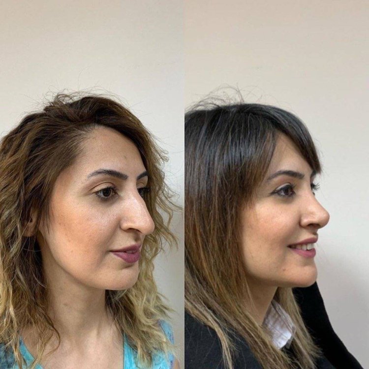 Ринопластика большого носа