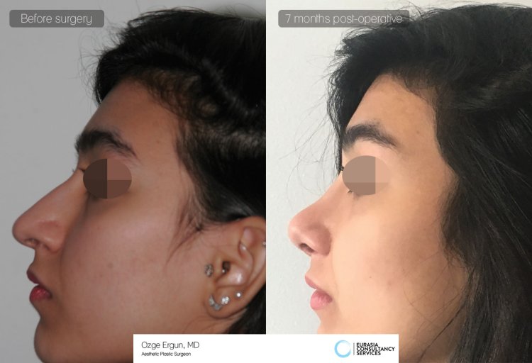 Ринопластика грузинского носа