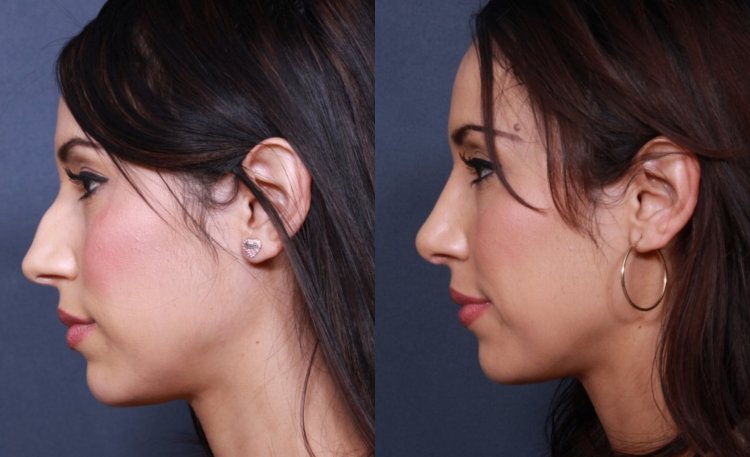 Турецкий нос ринопластика