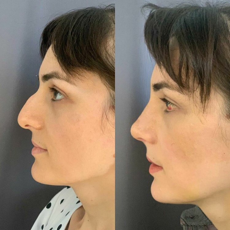 Аугментационная ринопластика