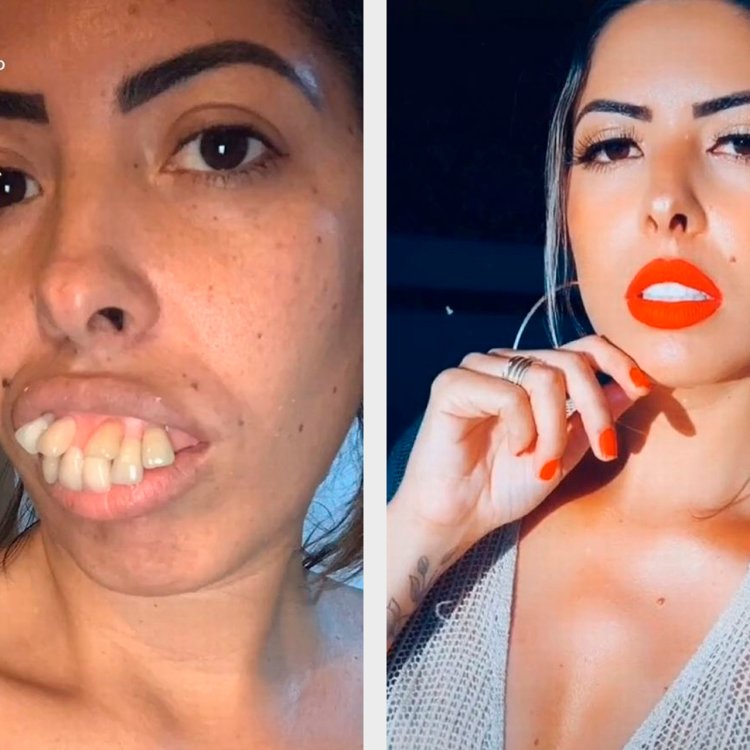 Девушка с имплантами на щеках