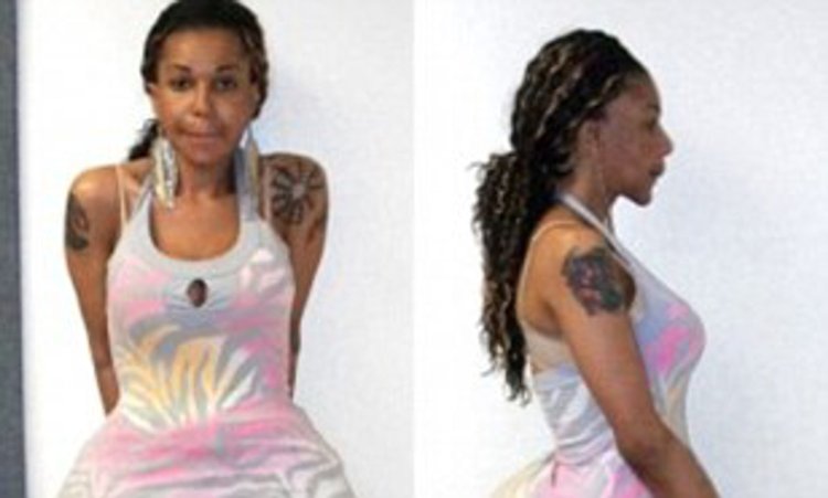 Импланты в ягодицы неудачные